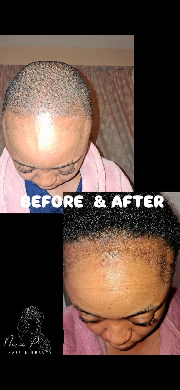 Before and after results using MISSP Hair Growth Oil